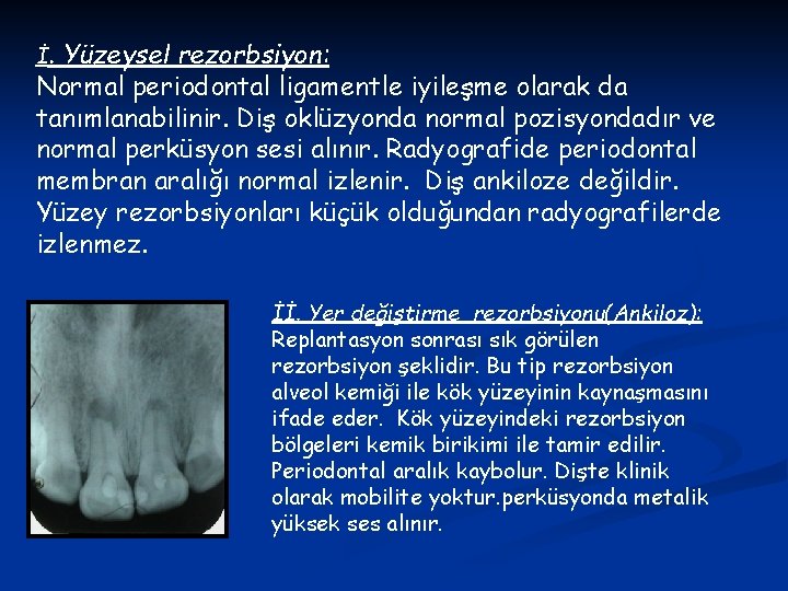 İ. Yüzeysel rezorbsiyon: Normal periodontal ligamentle iyileşme olarak da tanımlanabilinir. Diş oklüzyonda normal pozisyondadır