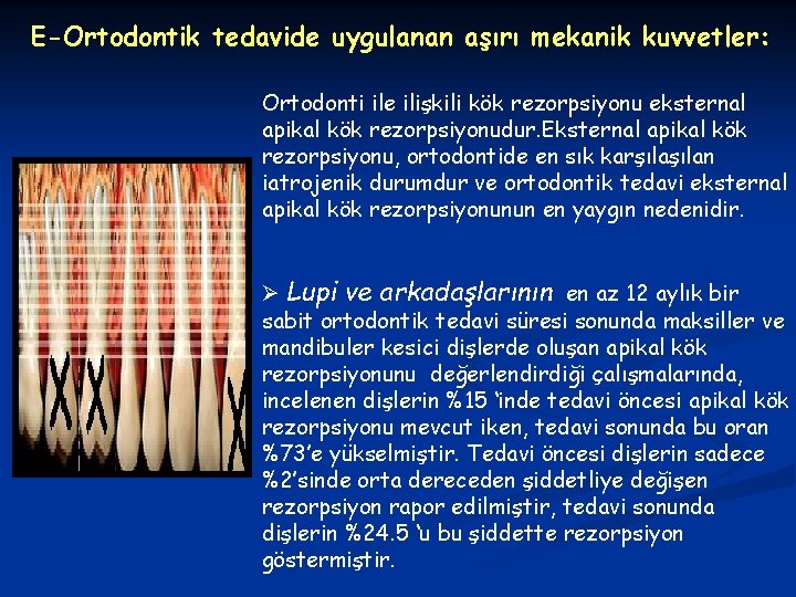 E-Ortodontik tedavide uygulanan aşırı mekanik kuvvetler: Ortodonti ile ilişkili kök rezorpsiyonu eksternal apikal kök