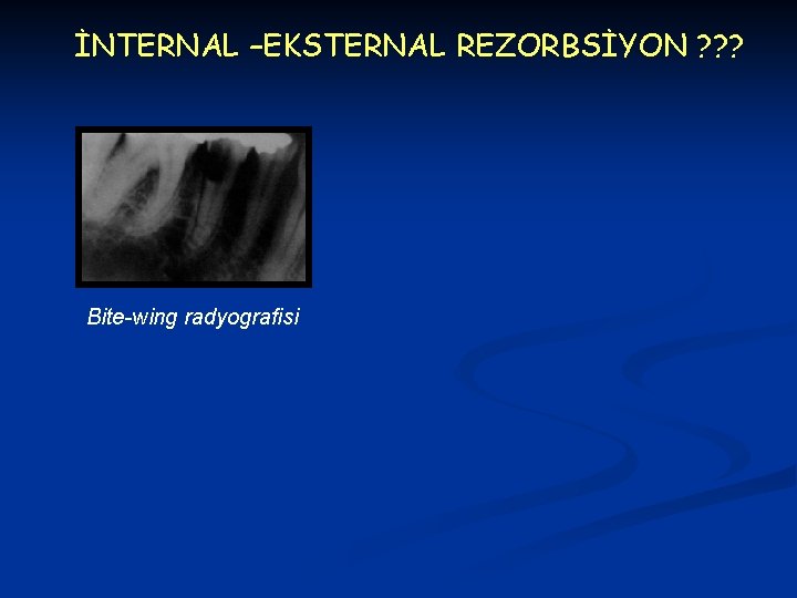 İNTERNAL –EKSTERNAL REZORBSİYON ? ? ? Bite-wing radyografisi 