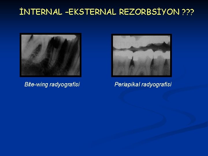 İNTERNAL –EKSTERNAL REZORBSİYON ? ? ? Bite-wing radyografisi Periapikal radyografisi 