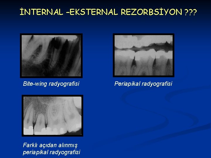 İNTERNAL –EKSTERNAL REZORBSİYON ? ? ? Bite-wing radyografisi Farklı açıdan alınmış periapikal radyografisi Periapikal