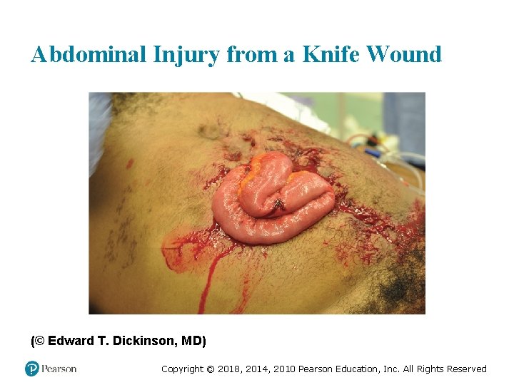 Abdominal Injury from a Knife Wound (© Edward T. Dickinson, MD) Copyright © 2018,
