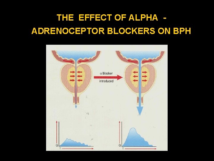THE EFFECT OF ALPHA ADRENOCEPTOR BLOCKERS ON BPH 