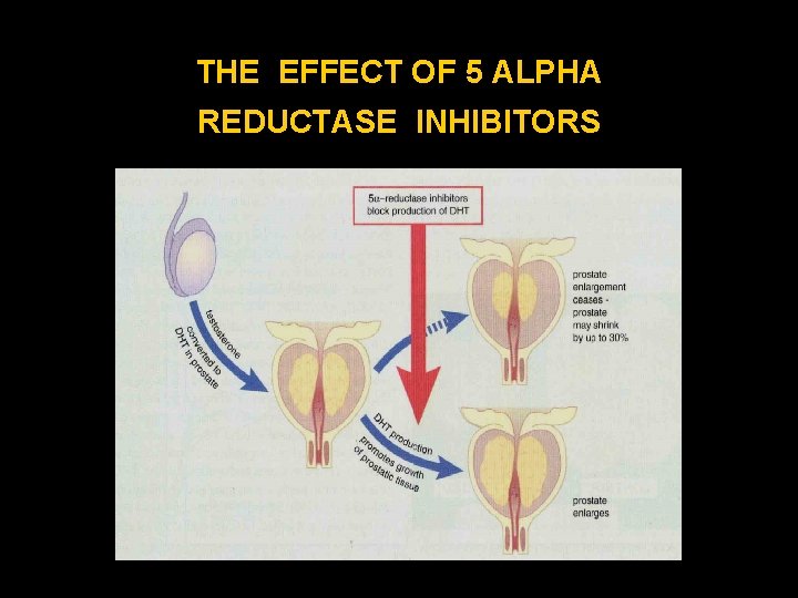 THE EFFECT OF 5 ALPHA REDUCTASE INHIBITORS 