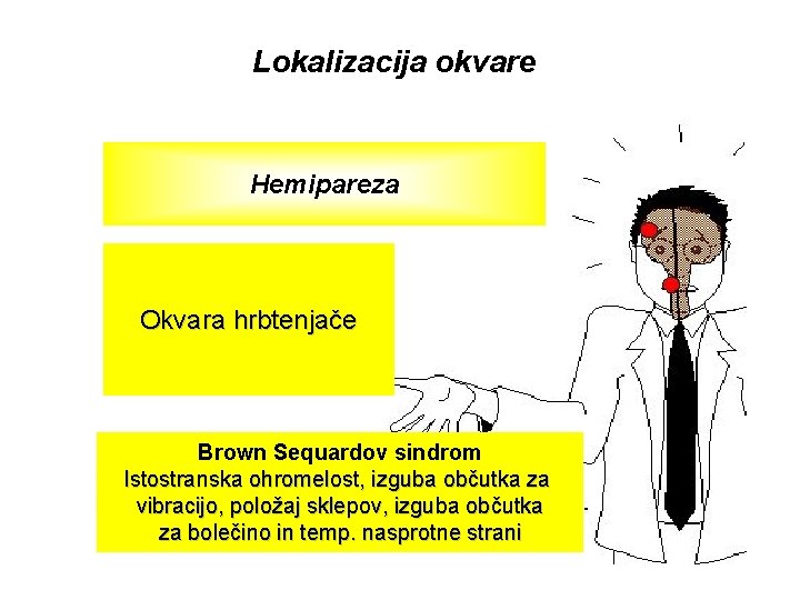 Lokalizacija okvare Hemipareza Okvara hrbtenjače Brown Sequardov sindrom Istostranska ohromelost, izguba občutka za vibracijo,