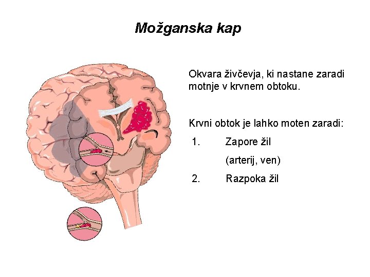 Možganska kap Okvara živčevja, ki nastane zaradi motnje v krvnem obtoku. Krvni obtok je