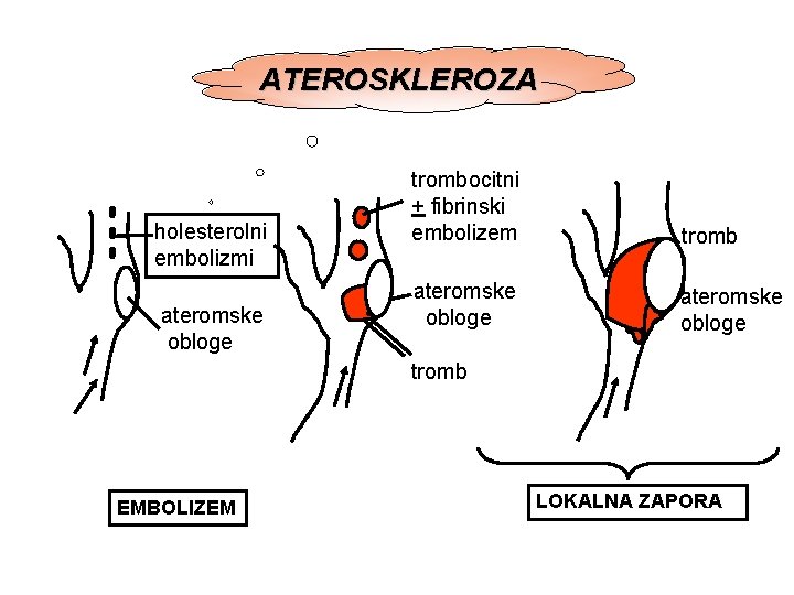 ATEROSKLEROZA holesterolni embolizmi ateromske obloge trombocitni + fibrinski embolizem tromb ateromske obloge tromb EMBOLIZEM