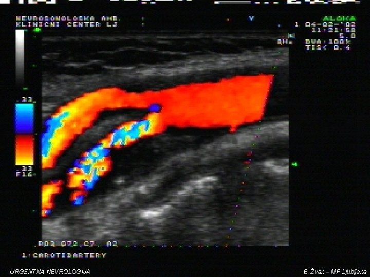 URGENTNA NEVROLOGIJA B. Žvan – MF Ljubljana 