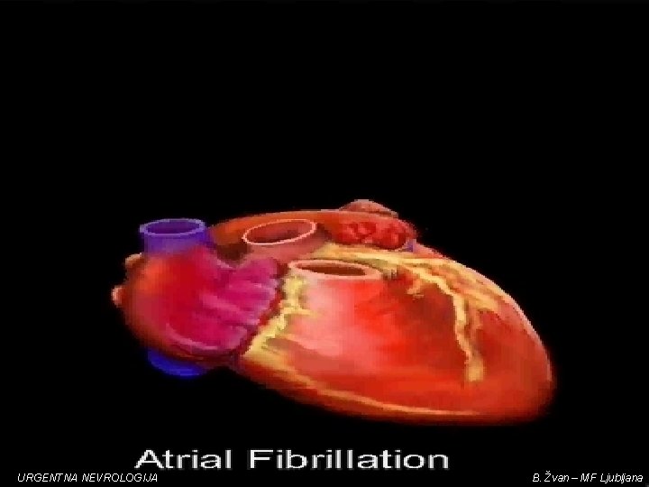 URGENTNA NEVROLOGIJA B. Žvan – MF Ljubljana 