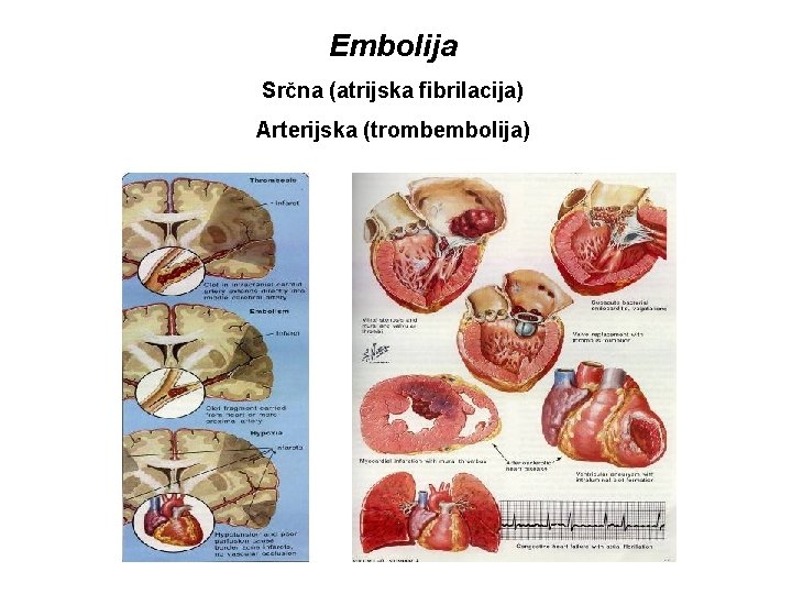 Embolija Srčna (atrijska fibrilacija) Arterijska (trombembolija) URGENTNA NEVROLOGIJA B. Žvan – MF Ljubljana 
