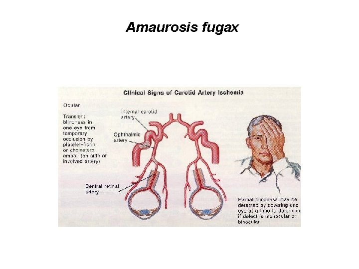 Amaurosis fugax URGENTNA NEVROLOGIJA B. Žvan – MF Ljubljana 