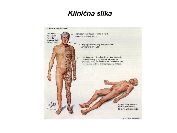 Klinična slika URGENTNA NEVROLOGIJA B. Žvan – MF Ljubljana 