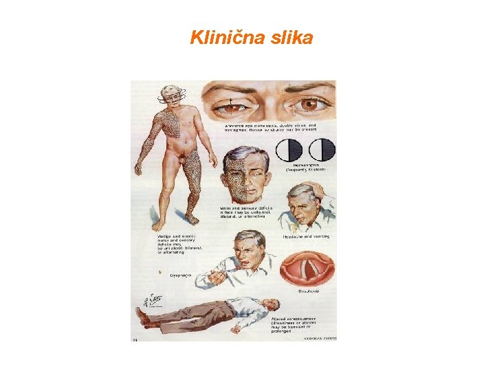 Klinična slika URGENTNA NEVROLOGIJA B. Žvan – MF Ljubljana 