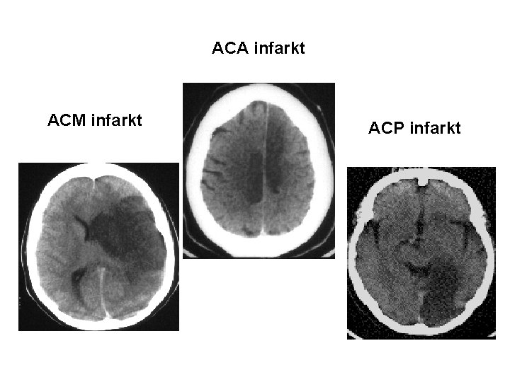 ACA infarkt ACM infarkt URGENTNA NEVROLOGIJA ACP infarkt B. Žvan – MF Ljubljana 