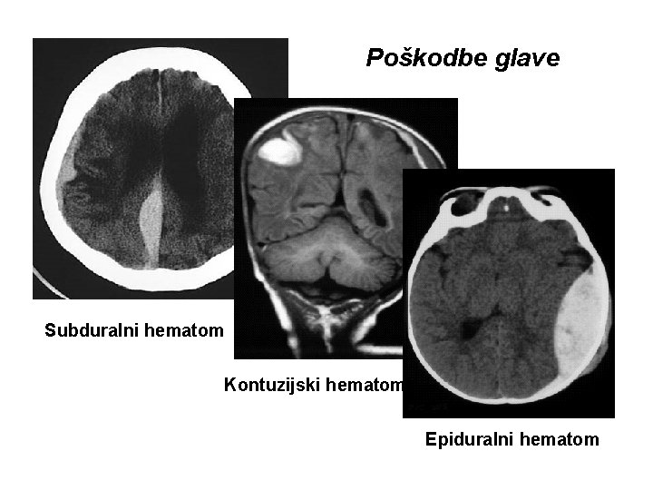 Poškodbe glave Subduralni hematom Kontuzijski hematom Epiduralni hematom URGENTNA NEVROLOGIJA B. Žvan – MF