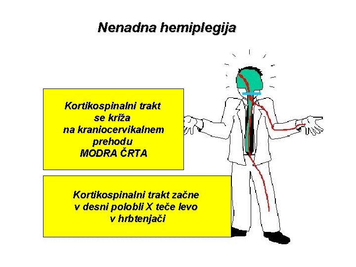 Nenadna hemiplegija Kortikospinalni trakt se križa na kraniocervikalnem prehodu MODRA ČRTA Kortikospinalni trakt začne