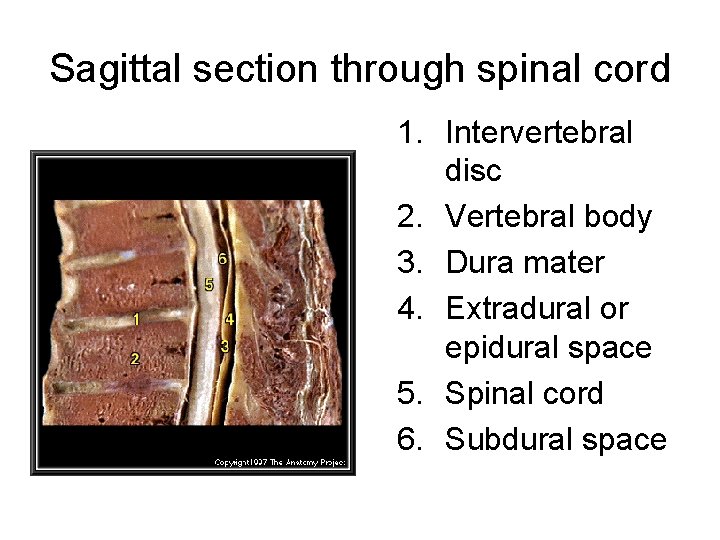 Sagittal section through spinal cord 1. Intervertebral disc 2. Vertebral body 3. Dura mater