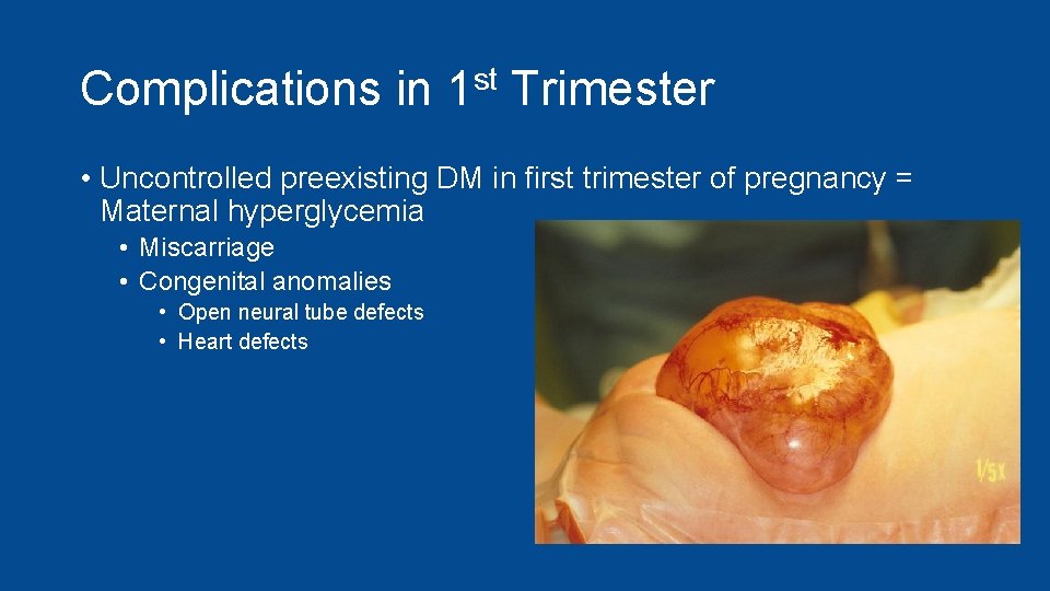 Complications in 1 st Trimester • Uncontrolled preexisting DM in first trimester of pregnancy