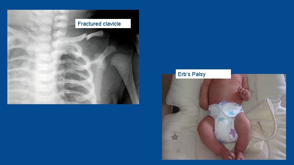 Fractured clavicle Erb’s Palsy 