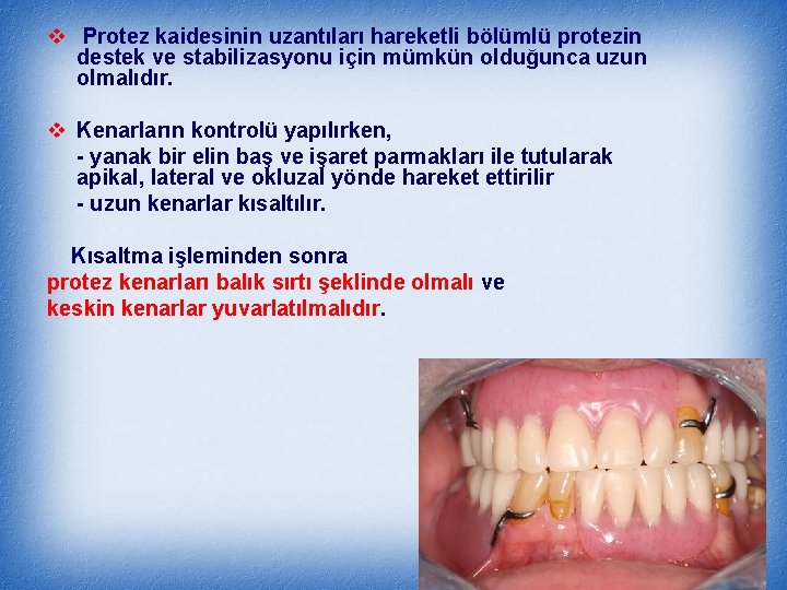 v Protez kaidesinin uzantıları hareketli bölümlü protezin destek ve stabilizasyonu için mümkün olduğunca uzun