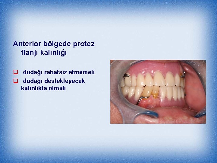 Anterior bölgede protez flanjı kalınlığı q dudağı rahatsız etmemeli q dudağı destekleyecek kalınlıkta olmalı