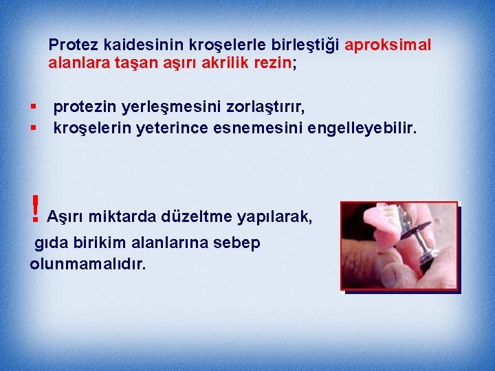 Protez kaidesinin kroşelerle birleştiği aproksimal alanlara taşan aşırı akrilik rezin; § protezin yerleşmesini zorlaştırır,