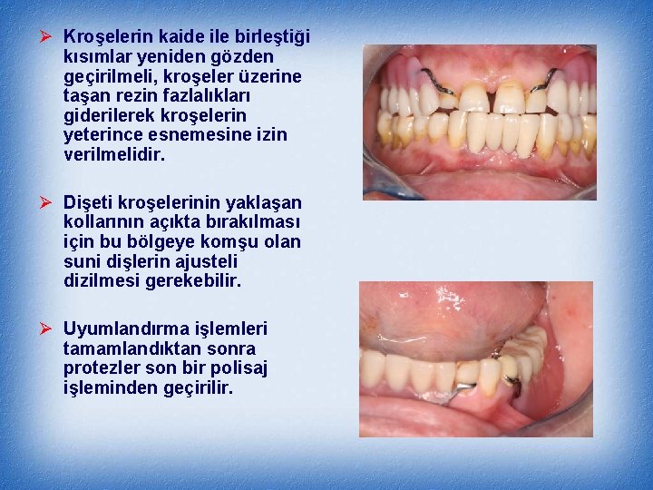 Ø Kroşelerin kaide ile birleştiği kısımlar yeniden gözden geçirilmeli, kroşeler üzerine taşan rezin fazlalıkları