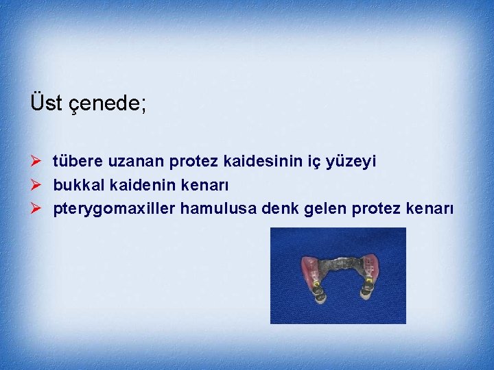 Üst çenede; Ø tübere uzanan protez kaidesinin iç yüzeyi Ø bukkal kaidenin kenarı Ø