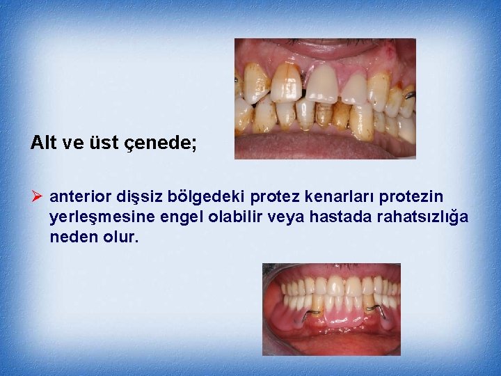 Alt ve üst çenede; Ø anterior dişsiz bölgedeki protez kenarları protezin yerleşmesine engel olabilir