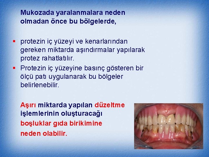 Mukozada yaralanmalara neden olmadan önce bu bölgelerde, § protezin iç yüzeyi ve kenarlarından gereken