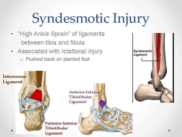 Syndesmotic Injury • “High Ankle Sprain” of ligaments between tibia and fibula • Associated