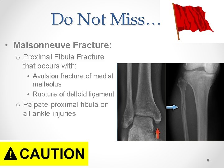 Do Not Miss… • Maisonneuve Fracture: o Proximal Fibula Fracture that occurs with: •