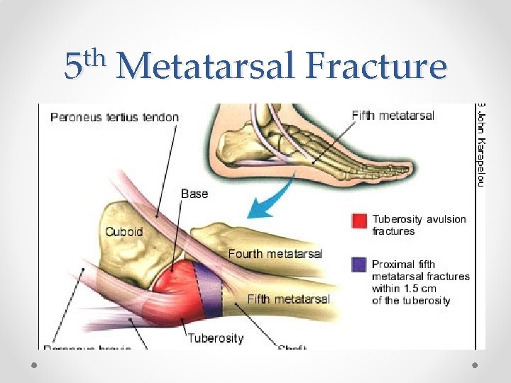 th 5 Metatarsal Fracture 