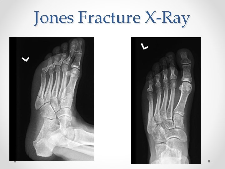 Jones Fracture X-Ray 