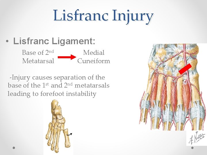 Lisfranc Injury • Lisfranc Ligament: Base of 2 nd Metatarsal Medial Cuneiform -Injury causes