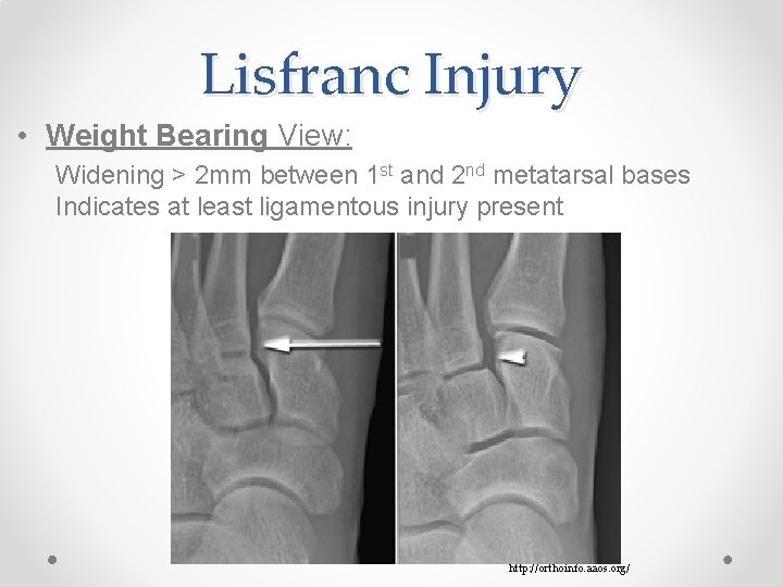 Lisfranc Injury • Weight Bearing View: Widening > 2 mm between 1 st and