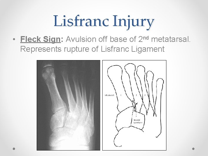 Lisfranc Injury • Fleck Sign: Avulsion off base of 2 nd metatarsal. Represents rupture