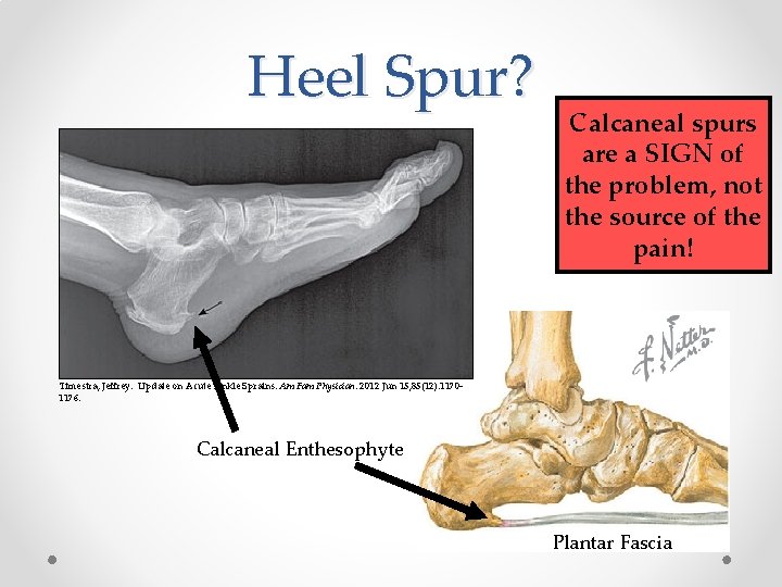Heel Spur? Calcaneal spurs are a SIGN of the problem, not the source of