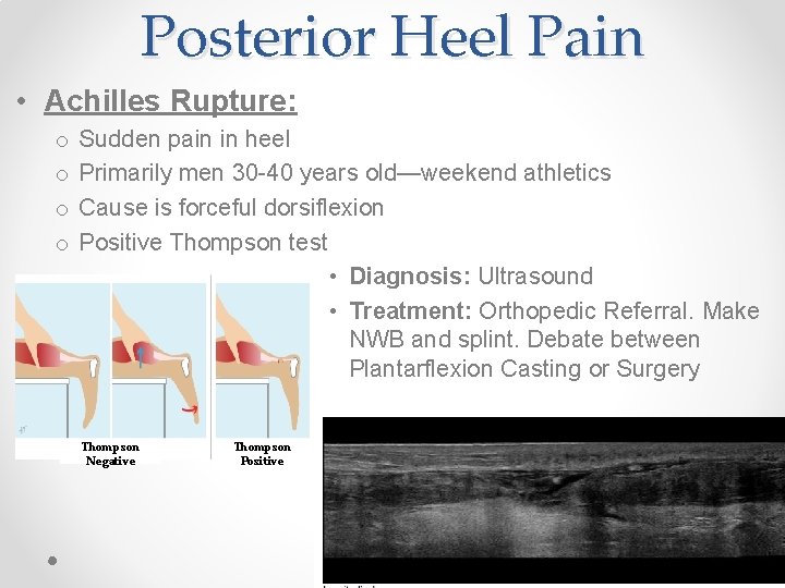 Posterior Heel Pain • Achilles Rupture: o o Sudden pain in heel Primarily men
