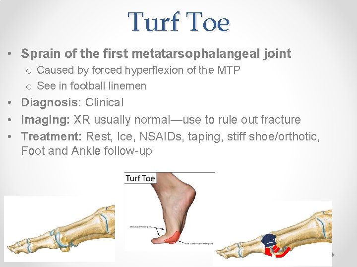 Turf Toe • Sprain of the first metatarsophalangeal joint o Caused by forced hyperflexion