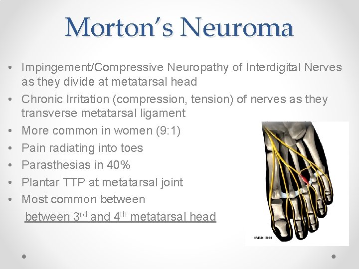 Morton’s Neuroma • Impingement/Compressive Neuropathy of Interdigital Nerves as they divide at metatarsal head