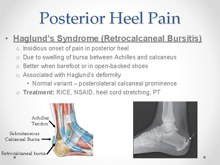 Posterior Heel Pain • Haglund’s Syndrome (Retrocalcaneal Bursitis) Insidious onset of pain in posterior