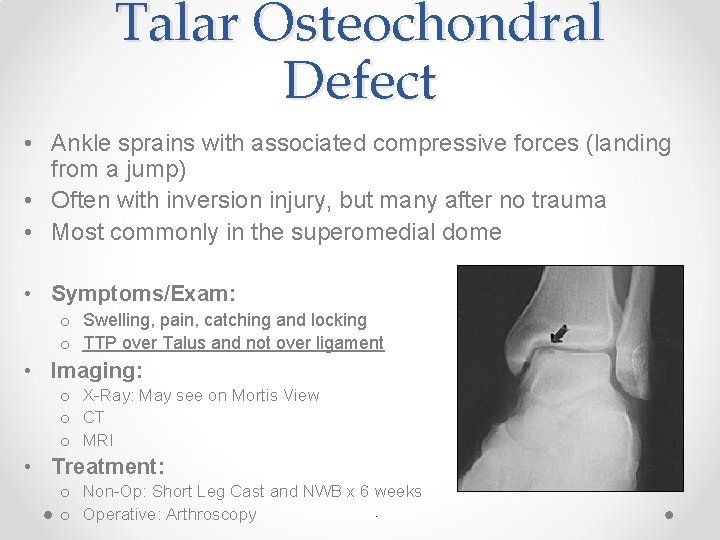 Talar Osteochondral Defect • Ankle sprains with associated compressive forces (landing from a jump)