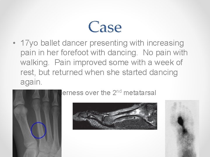 Case • 17 yo ballet dancer presenting with increasing pain in her forefoot with