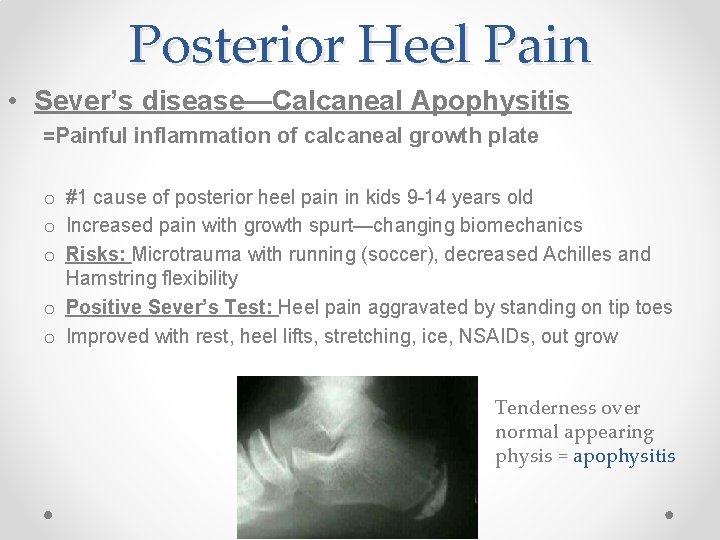 Posterior Heel Pain • Sever’s disease—Calcaneal Apophysitis =Painful inflammation of calcaneal growth plate o