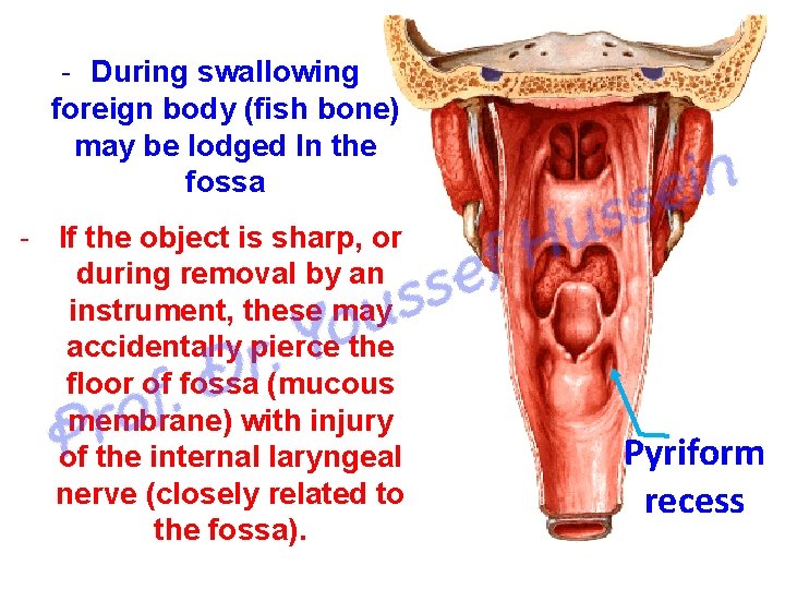  During swallowing foreign body (fish bone) may be lodged In the fossa If