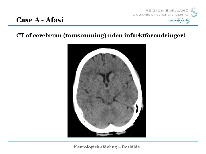 Case A - Afasi CT af cerebrum (tomscanning) uden infarktforandringer! Neurologisk afdeling – Roskilde