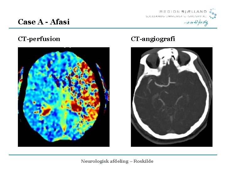 Case A - Afasi CT-perfusion CT-angiografi Neurologisk afdeling – Roskilde 