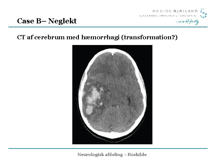 Case B– Neglekt CT af cerebrum med hæmorrhagi (transformation? ) Neurologisk afdeling – Roskilde