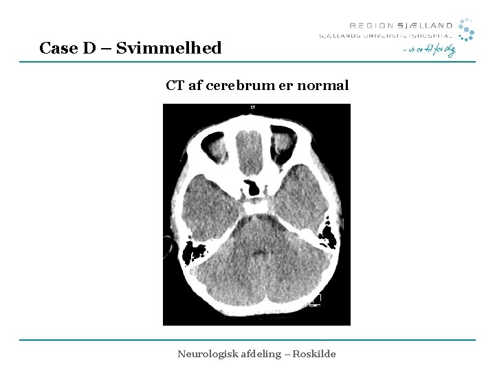 Case D – Svimmelhed CT af cerebrum er normal Neurologisk afdeling – Roskilde 